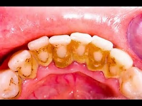 HOW TO REMOVE DENTAL PLAQUE IN 5 MINUTES NATURALLY WITHOUT GOING TO THE DENTIST HOW TO REMOVE DENTAL PLAQUE IN 5 MINUTES NATURALLY WITHOUT GOING TO THE DENTIST