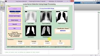 Lung Cancer Detection using Image Processing Matlab Project with Source Code