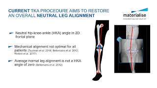 TKA Pre-Planning Tool to Restore Native Kinematics with Standard Cruciate-Retaining Implants