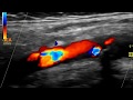 Carotid Doppler High Grade Stenosis Retrograde Vertebral Artery Flow Carotid Doppler High Grade Stenosis Retrograde Vertebral Artery Flow