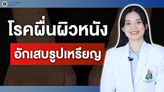 สุขภาพดีศิริราช ตอน โรคผื่นผิวหนังอักเสบรูปเหรียญ