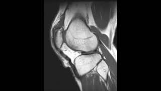 Quadriceps tendon tear