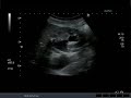 ultrasound of reflux of debris into renal pelvis 2.avi