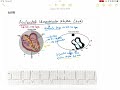 accelerated idioventricular rhythm aivr ekg ecg lecture