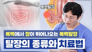 [복벽탈장] '탈장의 종류와 치료법(로봇탈장수술)' 복벽이 약해지는 요인