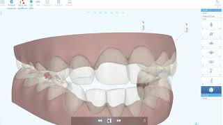 Invisalign : Courte démonstration du ClinCheck par Dr Fournier