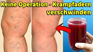 Keine Operation - Dieser Saft hilft Ihnen, Krampfadern schnell zu entfernen