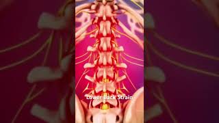 Lower Back Strain