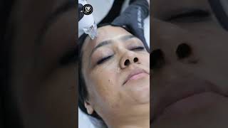 Facial Mesotherapy- Get rid of dull, tired skin, pigmentation \u0026 acne | #acne #pigmentation #shorts