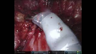 Dissection of Rectovaginal Endometriosis with Linear Stapled Nodulectomy of Multifocal Bowel Disease