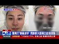 醫美打「蜂巢皮秒」 男臉部大面積出血燒燙傷