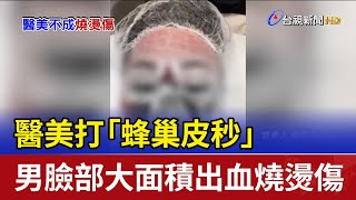 醫美打「蜂巢皮秒」 男臉部大面積出血燒燙傷