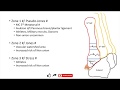 Jones fracture and Pseudo-Jones fracture ; differences