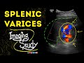 Splenic Varices || Ultrasound || Case 49