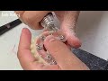 traditional vs. digital how to make screw retained hybrid pmma