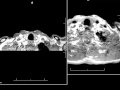 MRA of Neck with Intravascular agent