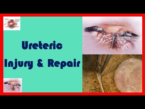 Can damaged ureter repair?