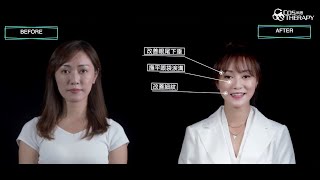 【👶🏻Derma Veil BB針 360°無死角膠原再生 即時塑型】