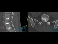 Dr. Brent Kimball - Lumbar Discogram and Disc Replacement