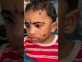 journey of a cleft child from birth to surgery amazing result shorts