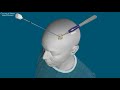 U of M brain implant stops tremors