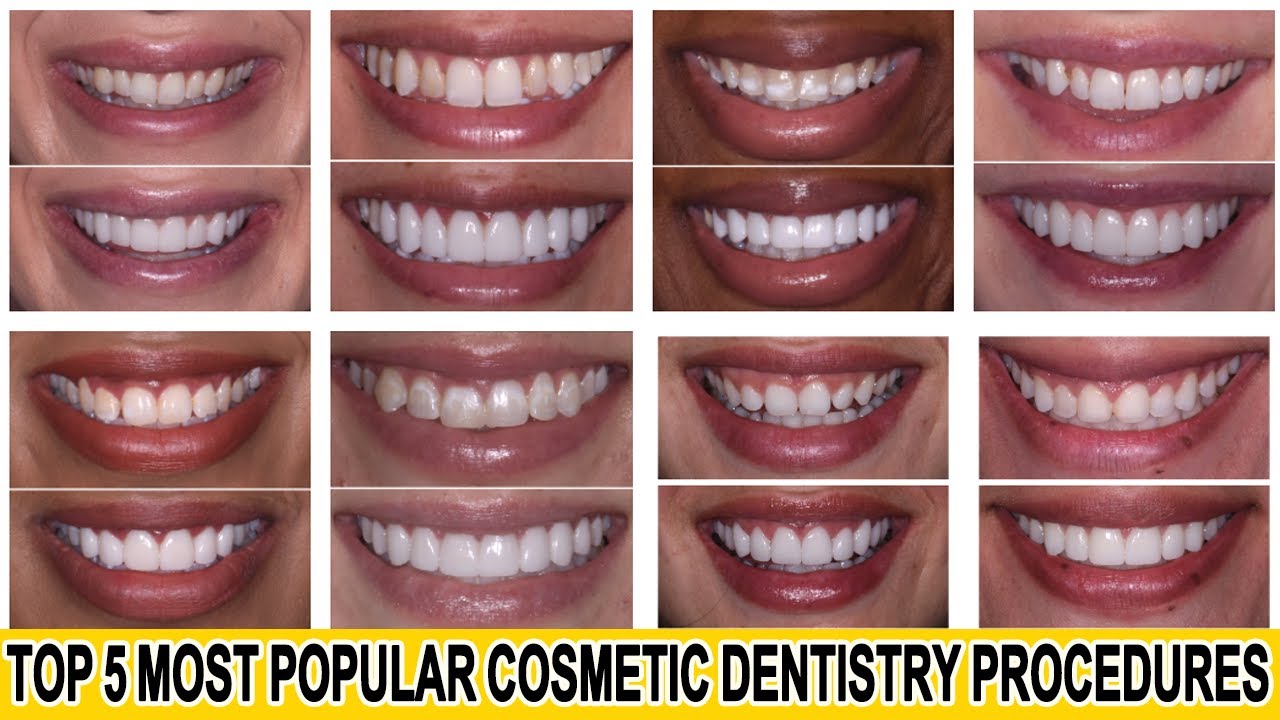 Top 5 Most Popular Cosmetic Dentistry Procedures Shorts