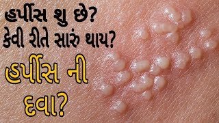 હર્પીસ વિશે સંપૂર્ણ માહિતી અને ઉપચાર- Herpes Treatment In Gujarati