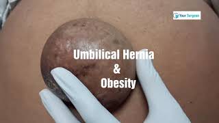 UMBILICAL HERNIA - IRREDUCIBLE