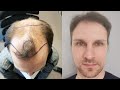 Hair Transplant Before and After - Month by Month results Elithair