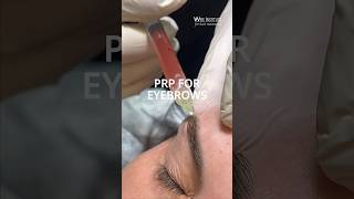 Do you want thicker brows? PRP works like fertilizer to existing hair follicles, stimulating growth