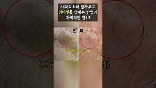 사과식초와 밀가루로 검버섯을 없애는 방법과 과학적인 이유