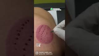 Hijama /cupping therapy by Dr.Rahoof.pm
