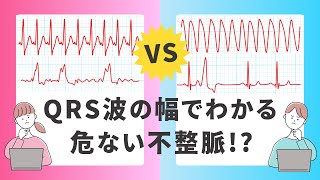 QRS幅で見抜く！上室性vs心室性不整脈の簡単判別法！