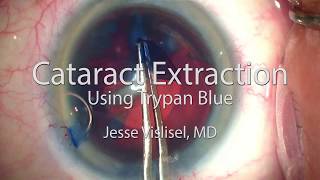 Cataract Extraction with Trypan Blue