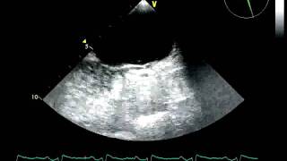 BUBBLE STUDY POSITIVE / SHUNT / PFO TUNNEL