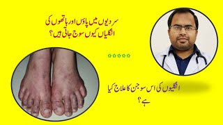 Itchy Toes in Winter || Chilblains || Treatment