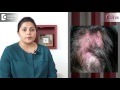 what causes scalp ringworm effective treatment tinea capitis dr. tina ramachander