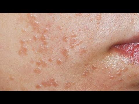 How to Get Rid of Flat Warts Fast - Easy Remove Warts How to Get Rid of Flat Warts Fast - Easy Remove Warts
