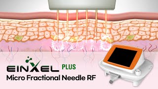 RF needle Einxel.