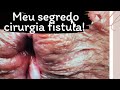 Dr Paulo Branco revela seu segredo sucesso cirurgia fístula perianal ha 37 anos: