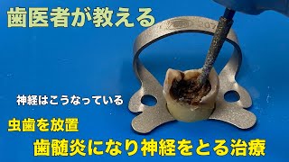 [Yokohama Naito Dental] Leave tooth decay! Treatment that turns into pulpitis and takes nerves.