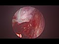 live surgery of csf cerebrospinal fluid leak repair live surgical procedure amrita ent