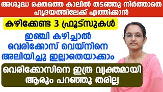 വെരിക്കോസ് വെയിനിനെ അലിയിപ്പിച്ചു ഇല്ലാതെയാക്കാം,| vericose vein maaraan malayalam | dr priya