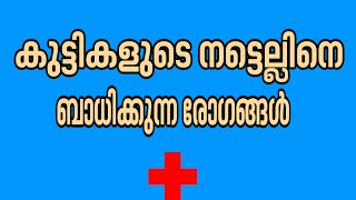 കുട്ടികളുടെ നട്ടെല്ലിനെ  ബാധിക്കുന്ന രോഗങ്ങള്‍:ഡോക്ടര്‍ ലൈവ്