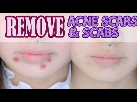 How to: Remove Acne Scars & Scabs How to: Remove Acne Scars & Scabs