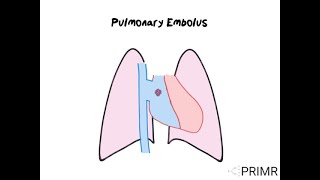 Pulmonary Embolus