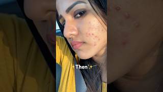 My acne journey 🥹 full video uploaded on my channel #krishnendhuunnikrishnan #acne #pimple