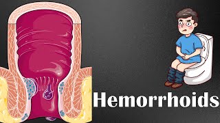 Hemorrhoids :- Types, Causes, Risk Factors, Signs & Symptoms, Diagnosis, & Treatment