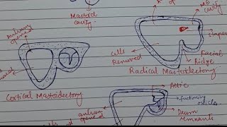 Mastoidectomy || Cortical , Radical , Modified Radical || Made Easy