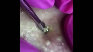 BLACKHEAD NEW THIS WEEK | REMOVAL | BLACKHEADS EXTRACTION COMPILATION | EAR BLACKHEADS THIS WEEK 700